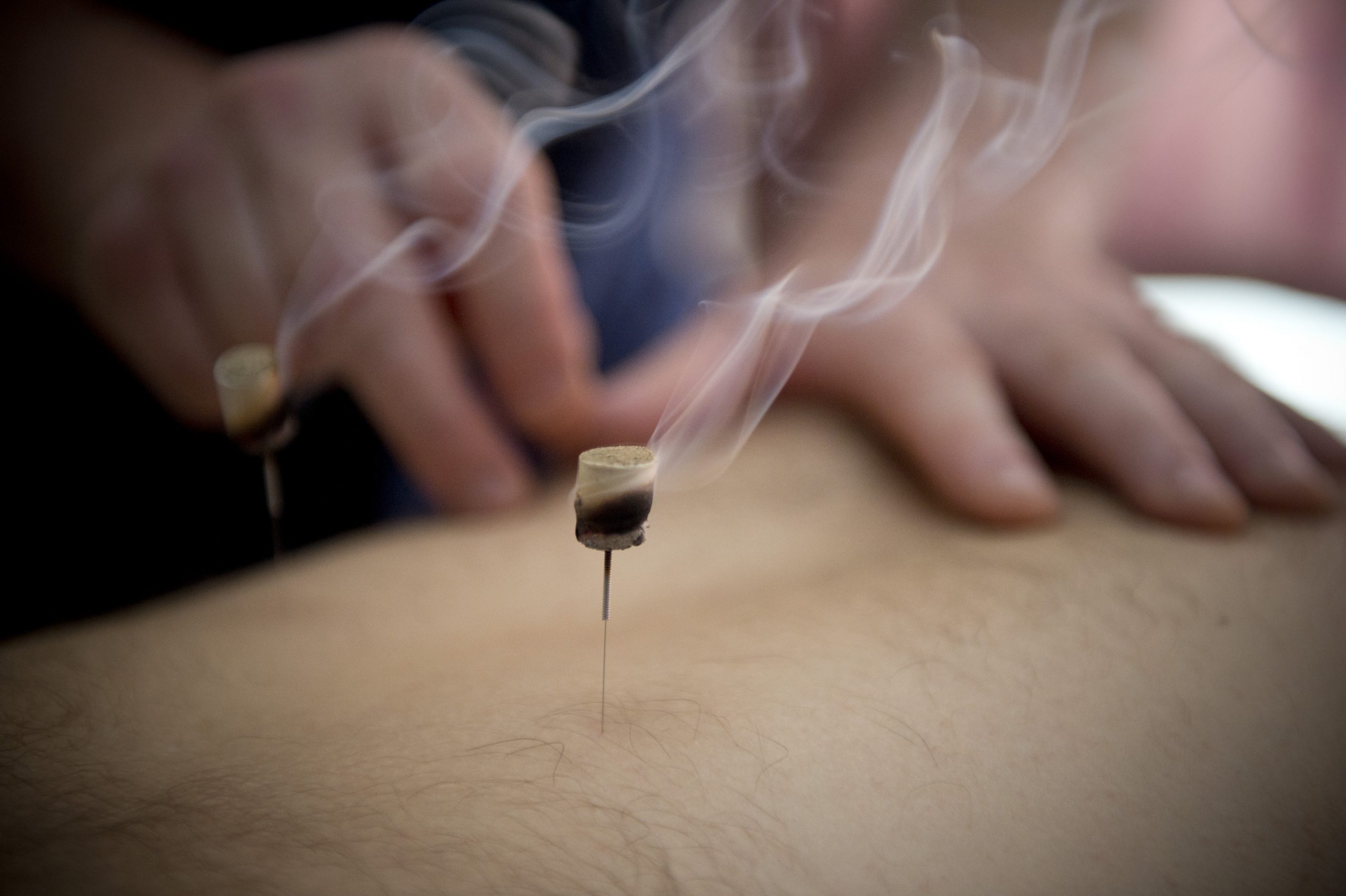 Moxibustion - Fire Needles with Steve Coster Acupuncture