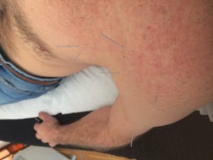 Shoulder Pain with Steve Coster Acupuncture